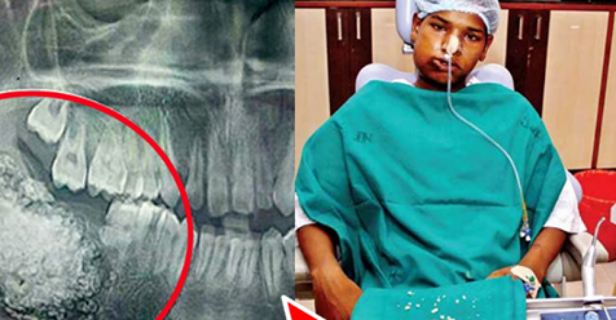 თინეიჯერმა ინდოელმა ბიჭუნამ ექიმები შოკში ჩააგდო-მას პირის ღრუში წარმოუდგენელი რაოდენობის კბილი აღმოაჩნდა!